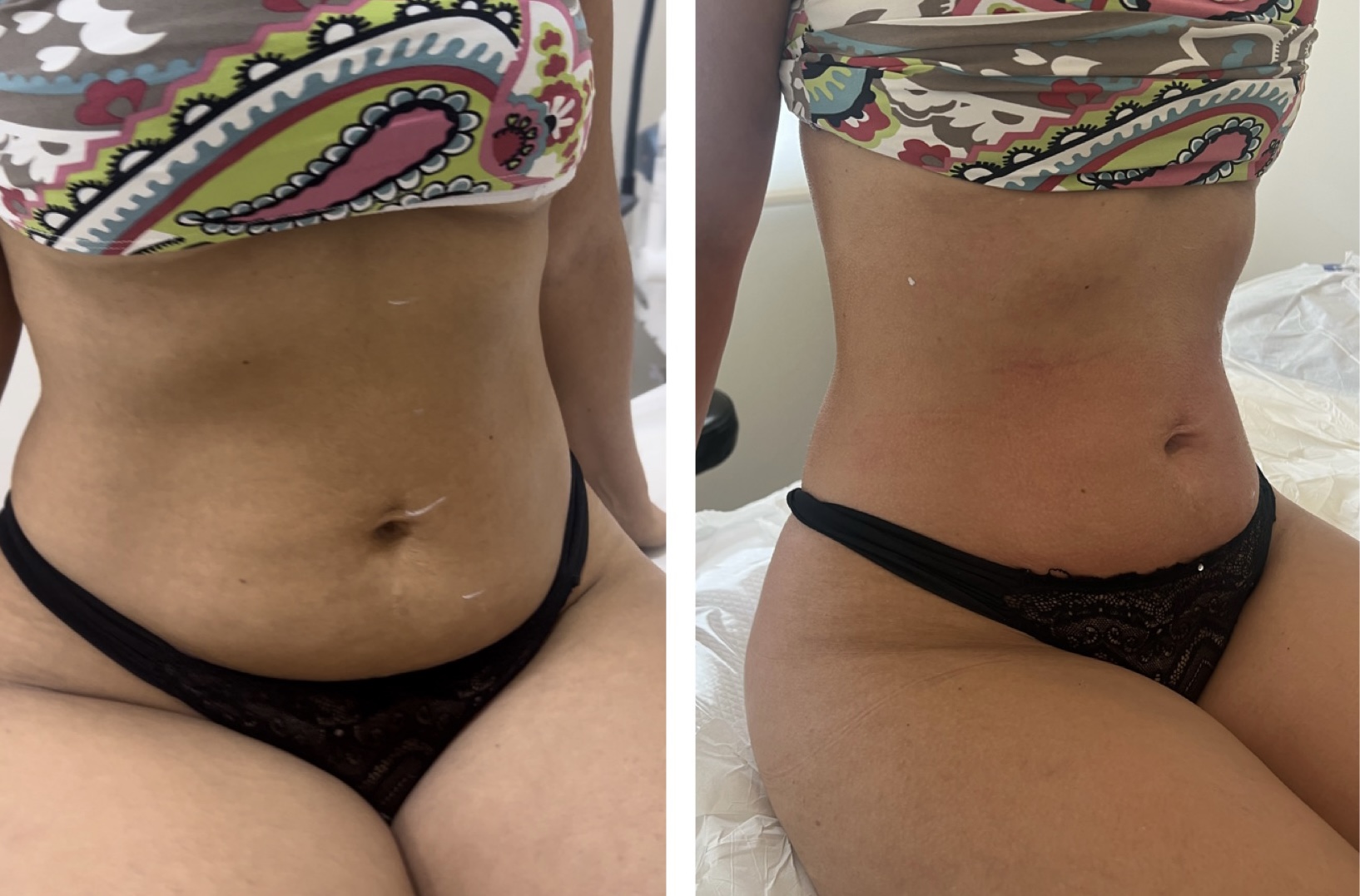 Registro de antes e depois de caso corporal autorizado